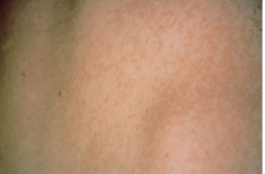 37yo M with 6-week history of the rash shown. Similar rash over the past 5 years resolved with Rx. Sun exposure, the rash becomes lighter than his tanned skin. Pharmacotherapy?