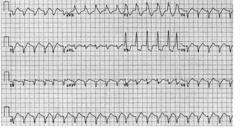 46) 70 yo W brought to ER 3hrs after onset of substernal chest pain, weakness and dsypnea. She had MI 6 months ago and has had recurrent chest paon on exertion treated with nitroglycerin. T98.8, rr 22, bp 60/40. Exam is normal. EKG is shown. Dx?