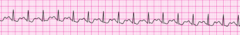 A 53-year-old man has shortness of breath, chest discomfort, and weakness. The patient's blood pressure is 102/59 mm Hg, the heart rate is 230/min, the respiratory rate is 16 breaths/min, and the pulse oximetry reading is 96%. The lead II ECG is displayed below. A patent peripheral IV is in place. What is the next action?