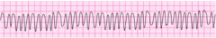 a patient has been resuscitated from cardiac arrest. During post-ROSC treatment, the patient becomes unresponsive, with the rhythm VT. What tx is indicated