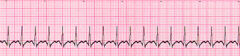 A patient has sudden onset of dizziness. The patient's heart rate is 180/min, blood pressure is 110/70 mm Hg, respiratory rate is 18 breaths/min, and pulse oximetry reading is 98% on room air. The lead II ECG is shown below: