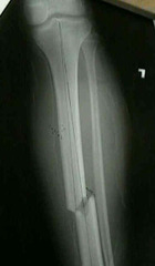 fracture fracture
