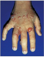 # Previously healthy 10yo boy with 2-day hx of pruritic rash on arms and legs, 24 hours after played in wooded area. No fever. Pet cat at home. Severe erythema and bullous lesions with discharge; there is a sharp line of demarcation between the rash and the unaffected skin. Pic shown. Recommendation to prevent recurrence?