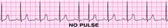 You have completed 2 min of CPR. The ECG monitor displays the lead below (PEA) and the patient has no pulse. You partner resumes chest compressions and an IV is in place. What management step is your next priority?