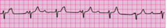 You have completed 2 minutes of CPR. The ECG monitor displays the lead II rhythm below, and the patient has no pulse. Another member of your team resumes chest compressions, and an IV is in place. What management step is your next priority?