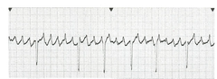 Atrial flutter