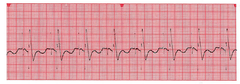 AV synchronous pacemaker rhythm