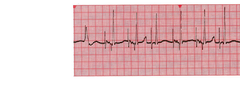 AV synchronous pacemaker rhythm
big spike before small