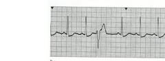 Regular sinus rhythm 
PVC