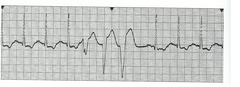 Regular sinus rhythm 
run of ventricular tachycardia