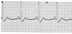 Sinus bradycardia