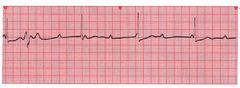 Third degree heart block 
ventricular escape beats