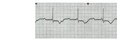 Third degree heart block